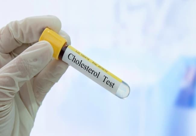 Cholesterol Test- Maintain Cholesterol Level