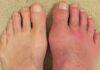 Gout Cause and Treatment for this rich man’s disease Gout Cause and Treatment