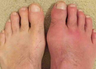 Gout Cause and Treatment for this rich man’s disease Gout Cause and Treatment