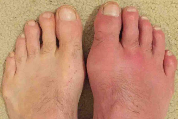 Gout Cause and Treatment