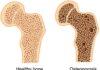 Osteoporosis cause and treatment possible with healthy lifestyle Osteoporosis cause and treatment