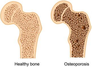 Osteoporosis cause and treatment possible with healthy lifestyle Osteoporosis cause and treatment