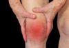 Arthritis and its forms to be learned by the common man Arthritis and its forms