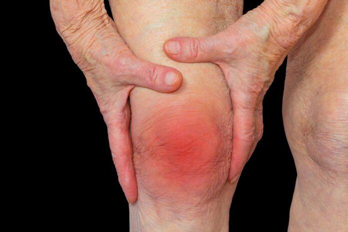 Arthritis and its forms